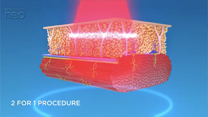 Manufacturer illustration of EMSCULPT NEO energy reaching fat and muscle layers